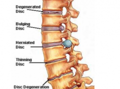 A IV disc herniation that causes some of the nucleus pulposus to leak out and impinge on descending nerve roots.