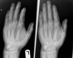 A fracture of the base of the metacarpal of the thumb