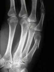 A fracture of the necks of the second and third metacarpals in professional boxers and the fifth metacarpal in unskilled boxers