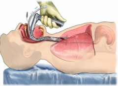 Endotracheal intubation since airway reflexes have been lost 
