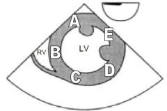 The diagram below is of a transgastric short axis view obtained during a transoesophageal echocardiography examination. Which letter corresponds to the area supplied by the right coronary artery?
A.	A
B.	B
C.	C
D.	D
E.	E