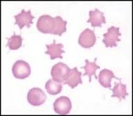 What cell is seen in this slide and what does it indicate?