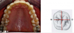 maxillary 1st molar