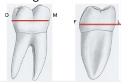 mandibular 1st molar, 
-think of how this tooth has 3 cusps on the buccal 