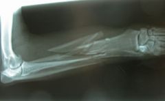 Name one of the bones that is fractured in this radiograph. (see image)