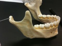 mandibular 2nd molar has 1 buccal groove versus the mandibular 1st molar has 2 grooves (buccal and disto-facial)