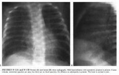 An otherwise healthy I -month-old girl with mild tachypnea.
