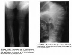 A child with short stature and multiple fractures
