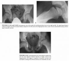 HISTORY
A 7-year-old white boy with right hip pain and a limp with no clinical or laboratory
fmdings suggesting further infection.