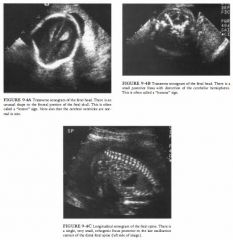 A 29-year-old pregnant woman referred for a routine fetal ultrasound.