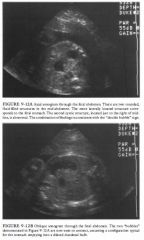 A 38-year-old woman referred for obstetric ultrasound at 27 menstrual weeks.