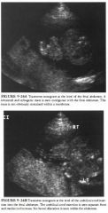 A 27-year-old pregnant woman is referred for an elevated maternal serum
alpha fetoprotein level at 16 menstrual weeks.