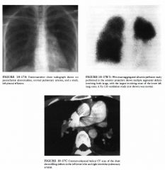 A 27-year-old woman being treated for gestational trophoblastic disease with a 36-
hour history of severe, intermittent, left pleuritic chest pain.
