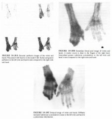 A 56-year-old woman with a history of left hand laceration and tendon repair to
the left fourth and ftfth digits. Several months later she developed pain and a burning
sensation in her left hand and fmgers.