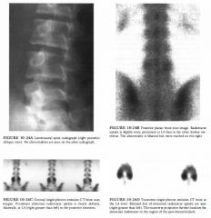 A 1 5-year-old boy with a 2-week history of severe lower back pain (worse on the
right) that had its onset while the patient was playing tennis. Mild point tenderness
is present at IA-L5, primarily on the right side.
