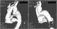 Findings
Extra border above aortic arch, along left paratracheal margin
No rib notching or other abnormality

Pseudocoarctation of aorta