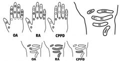 Rheumatoid arthritis of the hand and wrist 

This is a disorder of unknown etiology characterized by synovial inflammation, pannus formation, and then destruction of bone and cartilage.