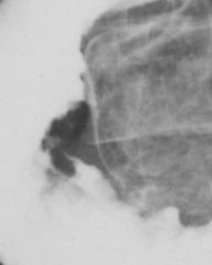 Papillary adenocarcinoma

Findings:
Abnormal enlargement of the papilla
ddx:
Edema from instrumentation or stone passage
Pancreatitis
Choledochocele
Polyp
Leiomyoma