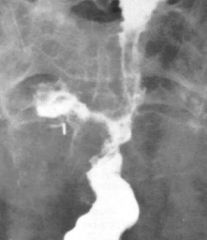 Radiation colitis

Findings:
Long segmental narrowing of the rectosigmoid colon
Focal sinus tract at the point of maximal narrowing
Loss of normal mucosal pattern
Evidence of prior abdominal surgery
ddx:
Crohn’s disease
TB
Mets
Lymphoma