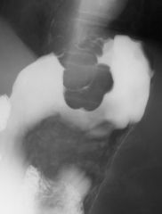 Hypertrophic pyloric stenosis

Findings:
Barium study in an infant shows a tight stenosis of the gastric pylorus = “string sign”
ddx:
NONE!
This is an Aunt Minnie!