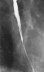 Long esophageal stricture

Findings:
long segment of esophageal narrowing
loss of normal mucosal pattern
ddx:
lye ingestion
Long-term nasogastric intubation
radiation