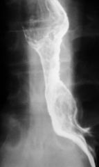 Barrett’s esophagus

Findings:
Segmental narrowing of the distal esophagus with smooth tapering margins, ulcerations, and loss of normal mucosal pattern
ddx:
GERD
radiation
malignancy