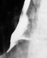 Boerhaave’s syndrome

Findings:
focal horizontal contrast extravasation in the posterior distal esophagus
surrounding abnormal posterior mucosa
ddx:
Iatrogenic
Tumor