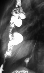Lye stricture & colonic interposition

Findings:
Long segmental distal esophageal narrowing
Anteriorly located  bowel loop connecting mouth of stomach = interposed colonic loop
ddx:
NONE!
This is an Aunt Minnie!