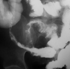 Crohn’s disease

Findings:
multiple loops of small bowel show segmental narrowing, loss of normal mucosal pattern (cobblestone), and fistula formation
striking involvement of the terminal ileum
ddx:
lymphoma
Tuberculosis
Yersinia (TI only)