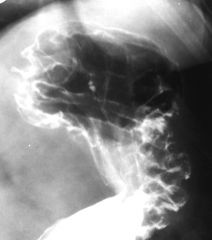 Gastric varicies

Findings:
Numerous serpentine thickened folds in the cardia and fundus along the greater curvature
Isolated – think splenic vein thrombosis
ddx:
Gastric adenocarcinoma
Lymphoma
Menetirier’s disease
