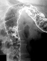 Ulcerative colitis &inflammatory polyps

Findings:
Ahaustral, granular mucosa of the hepatic flexure
Numerous scattered polypoid filling defects
ddx:
NONE!
This is an Aunt Minnie!