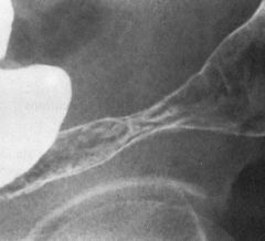 Ulcerative colitis &malignant stricture

Findings:
Ahaustral, granular mucosa = UC
Focal stricture  of the sigmoid
ddx:
Benign stricture
Ischemic stricture