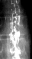 Esophageal varicies

Findings:
Numerous thickened and irregular folds along the entire length of esophagus
Appearance may change with luminal distention
ddx:
Varicoid esophageal carcinoma
