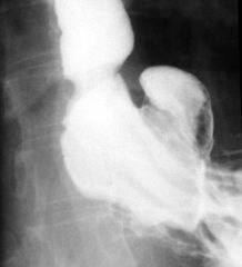 Paraesophageal hernia

Findings:
Hiatus hernia with a small paraesophageal component
If large enough, increased risk of gastric volvulus and strangulation
ddx:
NONE!
This is an Aunt Minnie!
