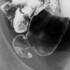 Meckel’s diverticulum

Findings:
Enteroclisis shows a single diverticulum along the antimesentic side of the distal small bowel
ddx:
NONE!
This is an Aunt Minnie!