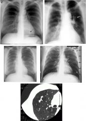 Bronchial atresia
CXR:
Well-expanded lungs with no pleural effusion
Tortuous nodular opacity in the left lower lobe (arrows)

CT:
Tubular branching opacity in LLL
Opacity has no identifiable connection with the adjacent vascular structures and does