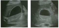 Lon g itudinal and tra nsverse views of the g a l l b ladder.
1 . Should the abnormality shown on these images move when the patient rolls?
2 . What causes the echogenicity of the bile in this condition?
3. Is surgery indicated?
4. What less common ca