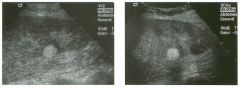 Two longitu d i n a l views of the lowe r pole of the same kidney.
1. What important finding is seen on the second image but not on the first?
2. Why doesn't the first unage show this important finding?
3 . Does this lesion requu'e further evaluation?
