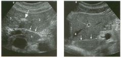 Transverse and longitudinal views of the l iver.
1 . What structure is the large arrow pointing to Ul the first image?
2. What structure are the small arrows pOinting to in both images?
3. What embryologic remnant travels in the structures uldicated by