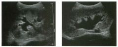 Long itudina l views of two patients with the same a bnorm a l ity.
1. What is wrong with these kidneys?
2. Under what circumstances is this a medical emergency?
3. How would you grade the abnormality shown here?
4 . In what plane are these images acq