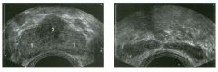 Transverse views of the prostate from a transrectal approac h . The seco nd
image was obtained s l ightly superior to the first.
1 . What zone of the prostate is indicated by the numbers 1 and 2 ?
2 . What structures are shown i n the second unage?
3.
