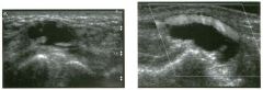 Tra nsverse view of the dorsal surface of the wrist and longitudinal view
of the vo lar surface of the wrist in two patients with the same
abnormal ity_
1 . What is the most common cause of cystic lesions in the wrist?
2. Where do these lesions most o
