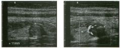 Tra nsverse g rey sca le and color Doppler views of the right lower
quadra nt.
1 . What is the sensitivity of ultrasound in making this diagnosis?
2. Is this diagnosis easier to make with ultrasound in children or in adults?
3. What are the sonographi