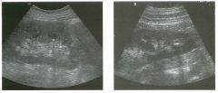 Lo ngitudinal views of two patients with the same a b norma l ity.
1 . Describe the abnormality seen in both of these kidneys.
2. How good is ultrasound at making this diagnosis?
3. Is the abnormality seen in these kidneys likely to be seen on CT?
4. 