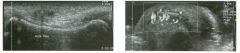 Lon g itud inal g rey-scale view and tra nsverse power Doppler view of the
proximal fifth finger.
1 . What are the pertinent findings?
2. What is the role of ultrasound in making this diagnosis?
3. What limits the ability of ultrasound to make this di