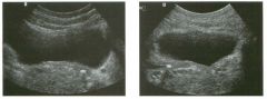 Transverse view of the pelvis j ust a bove the bladder trigone and
longitudina l view of the pelvis just to the left of the midline in a patient
who is 1 8 weeks preg nant.
1 . Describe the abnormality shown in this patient.
2. What is the role of ult