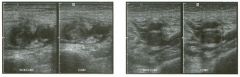 Tra nsverse views of the groin and mid thi g h .
1 . How good i s ultrasound a t malting this diagnosis in the thigh?
2. Is it possible to make this diagnosis reliably without color Doppler?
3. Does this condition most commonly produce unilateral or bi