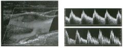 long itu dinal color Doppler view of the carotid bifu rcation and p u l sed
Doppler waveforms from the i nternal and extern al carotid a rteries. (See
color plates.)
1 . Identify the internal and the external carotid arteries on the color Doppler image