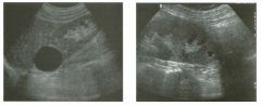 Long itud inal views of the kid ney i n two patients.
1 . Is ultrasound a good means of characterizing lesions such as the ones shown here?
2 . What are the three characteristics of this lesion?
3. What other lesions should be included in the different