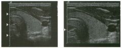 Two transverse views of the thyroid.
1 . What do the arrowheads a t the left side o f the images indicate?
2. Which image would you expect to have the higher frame rate?
3. What can you do to inlprove the frame rate while performing real-time scans?
4